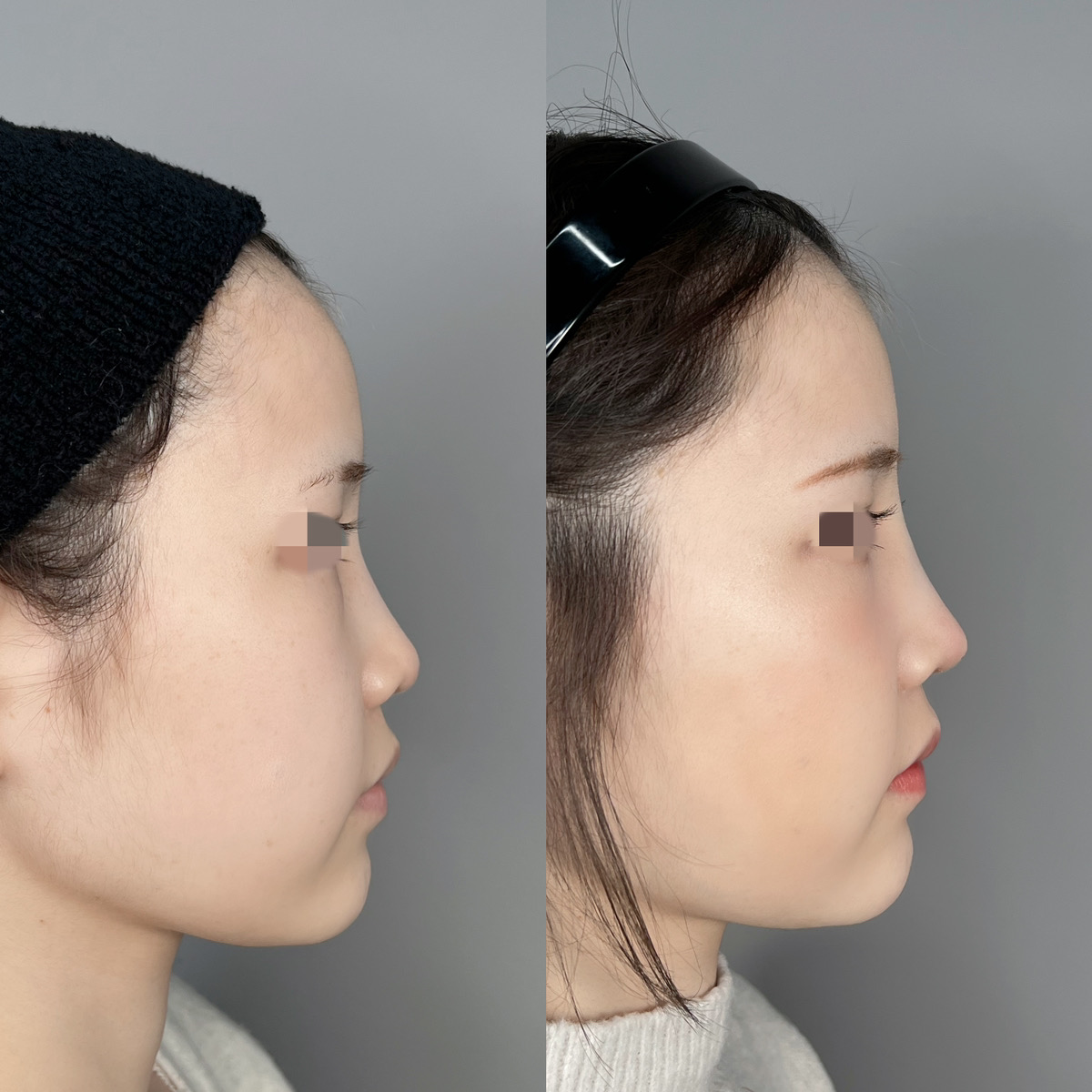 鼻尖形成とは？鼻の手術について解説！ | 【公式】ASTRA BEAUTY CLINIC