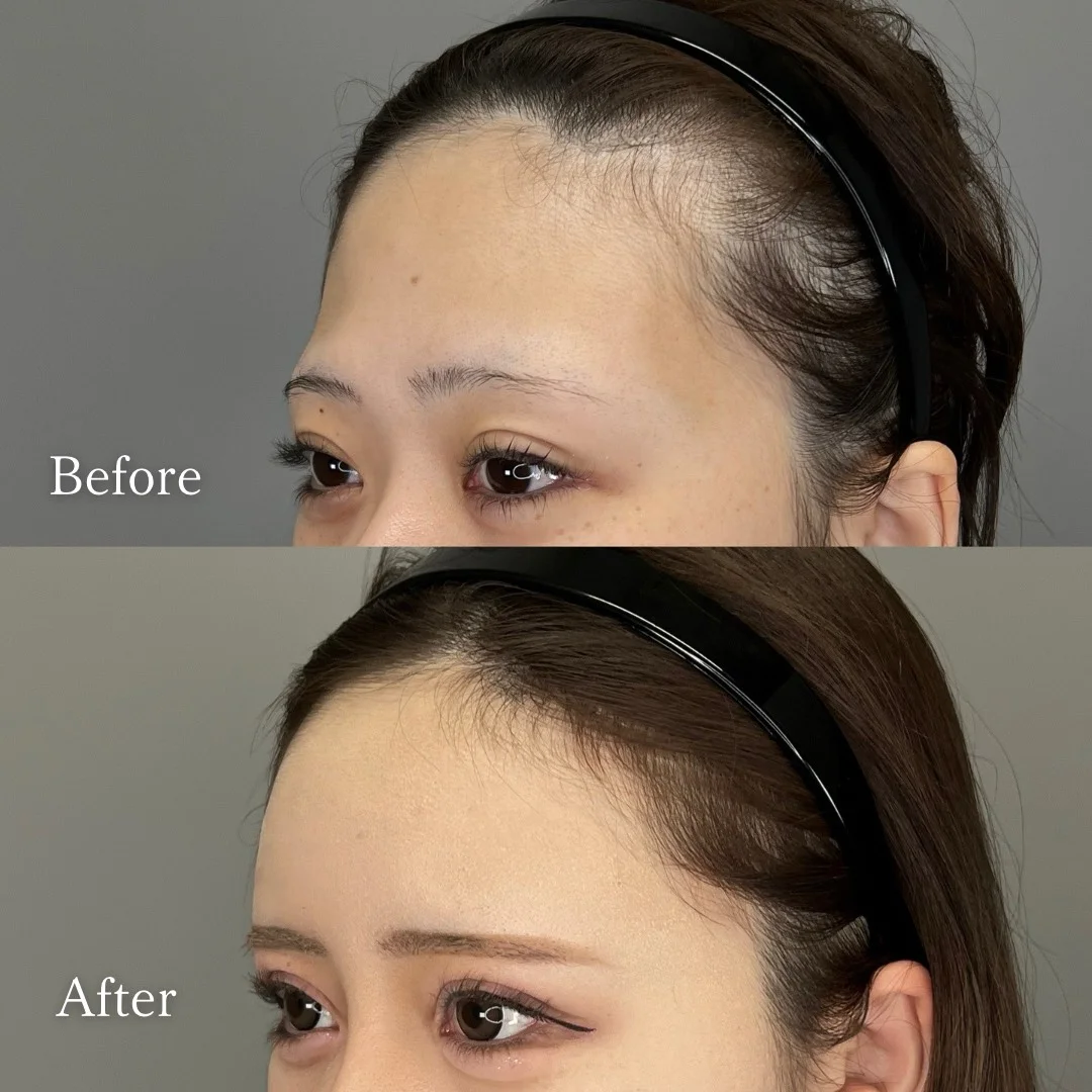 Before After